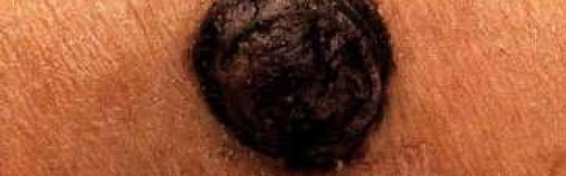 Il melanoma nodulare